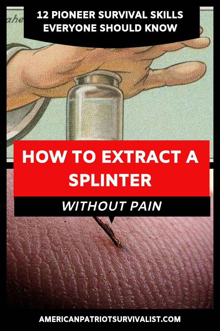 How to Extract a Splinter