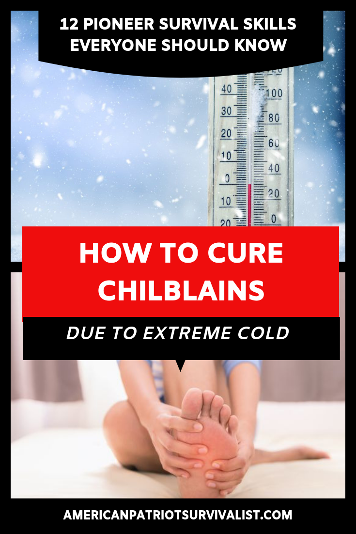 How to Cure Chilblains